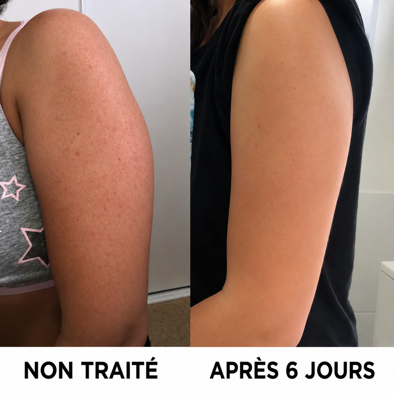 Comparaison avant/après VELISSE™