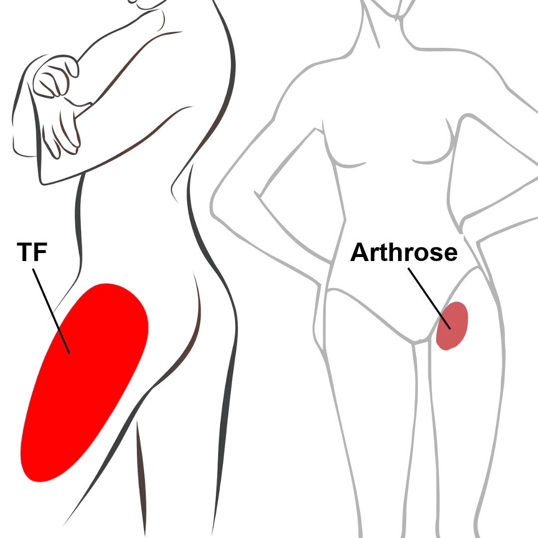 Schéma de localisation de la douleur : TF contre arthrose de la hanche